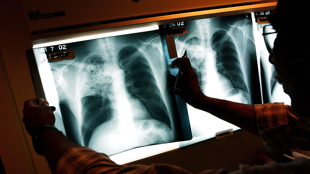2 active tuberculosis cases traced to San Francisco strip club — KTVU FOX 2 Bay Area, San Rafael Health news